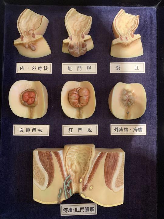 人体模型　標本　痔　痔疾模型　漢方　薬局　クリニック　鍼灸　整体　インテリア